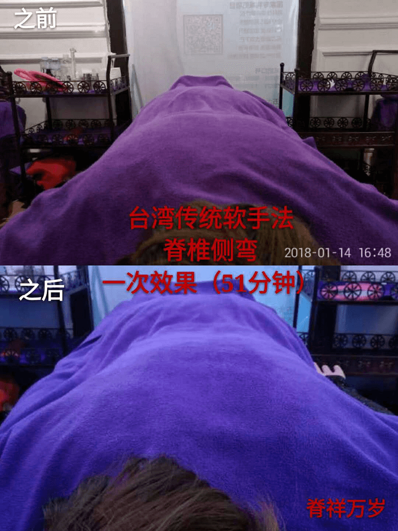 脊柱側(cè)彎