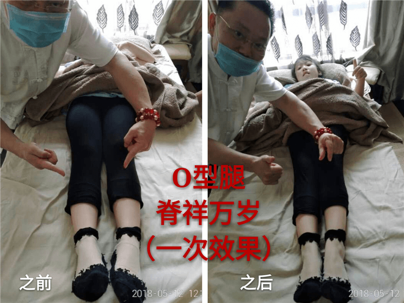 O、K混合型腿