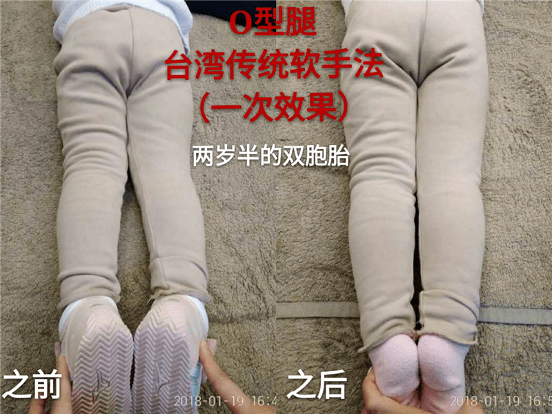 O、K混合型腿