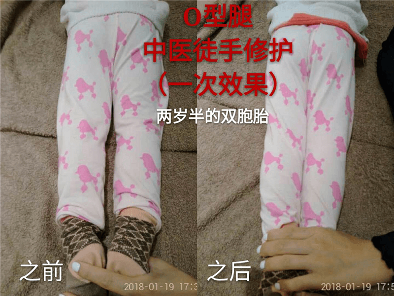 O、K混合型腿
