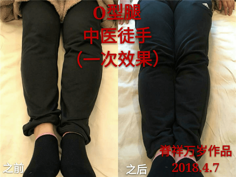 O、K混合型腿