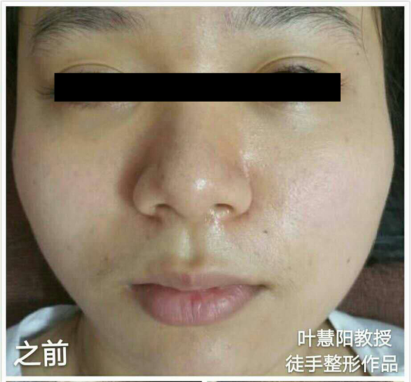 徒手整容
