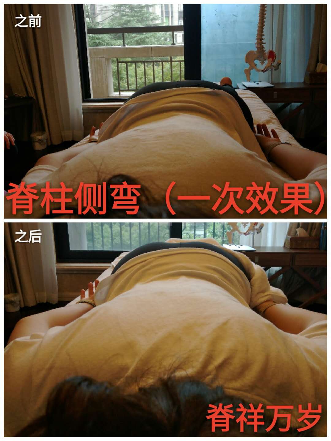 脊柱側(cè)彎