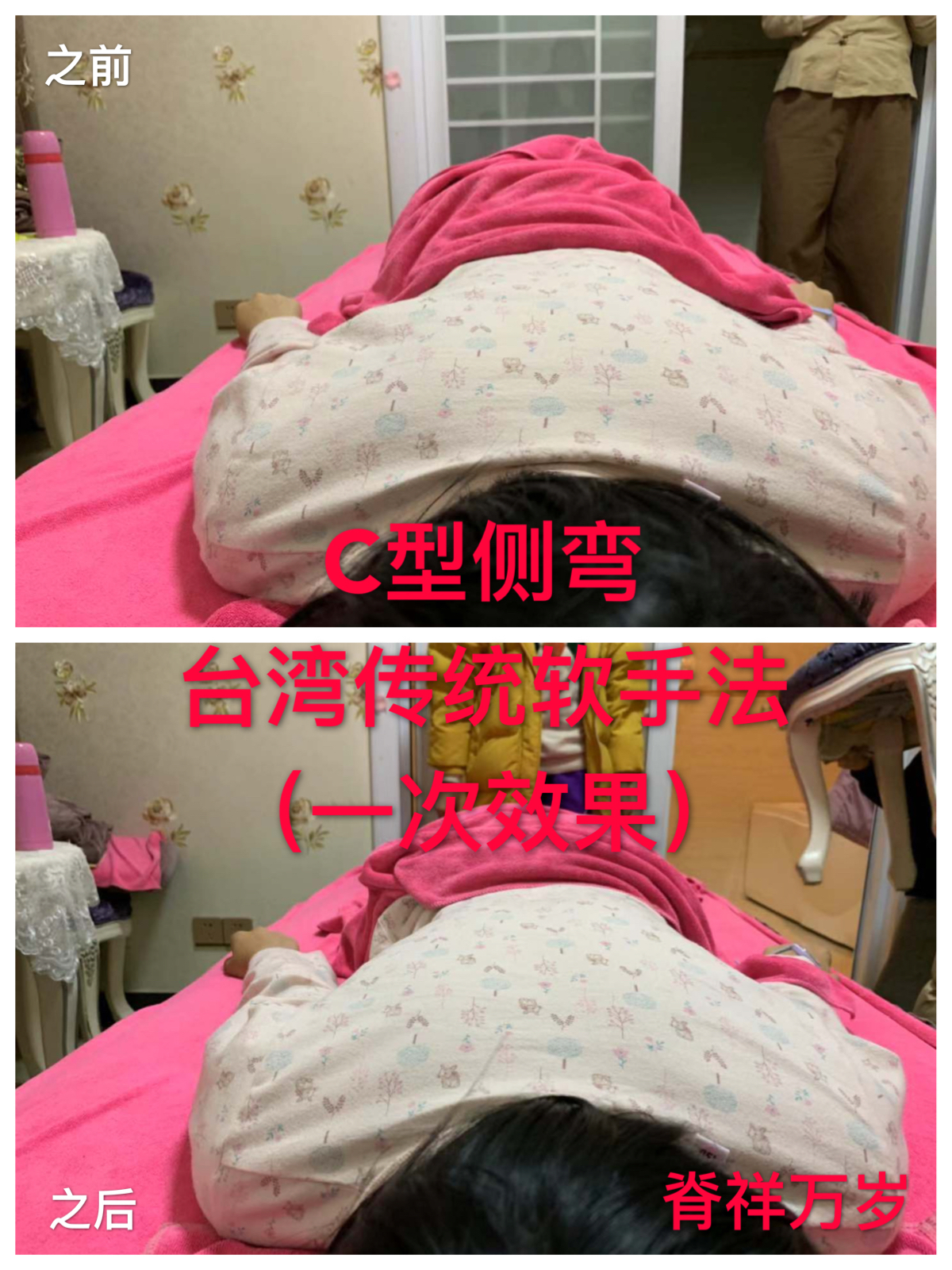 脊柱側(cè)彎