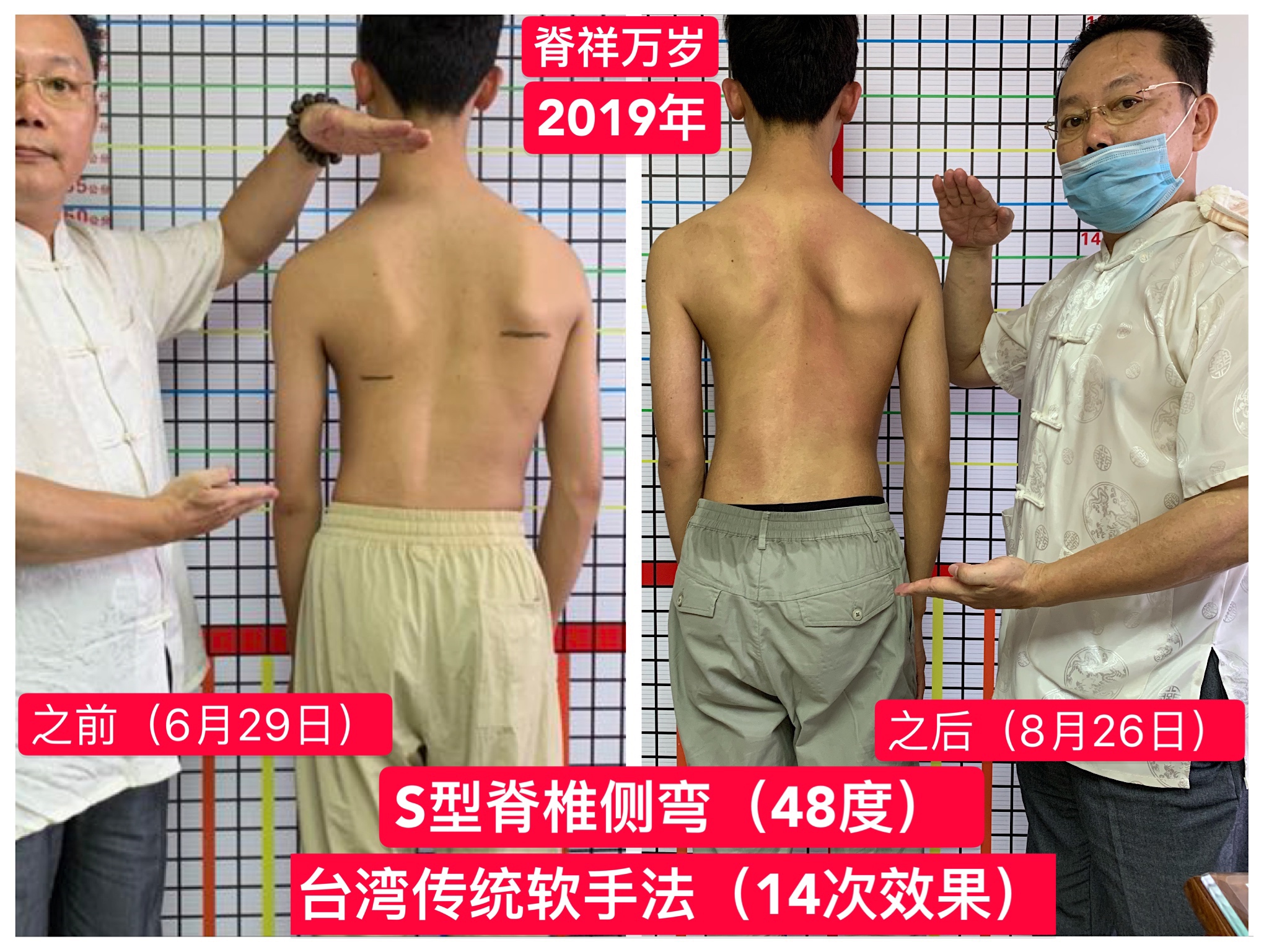 脊柱側(cè)彎