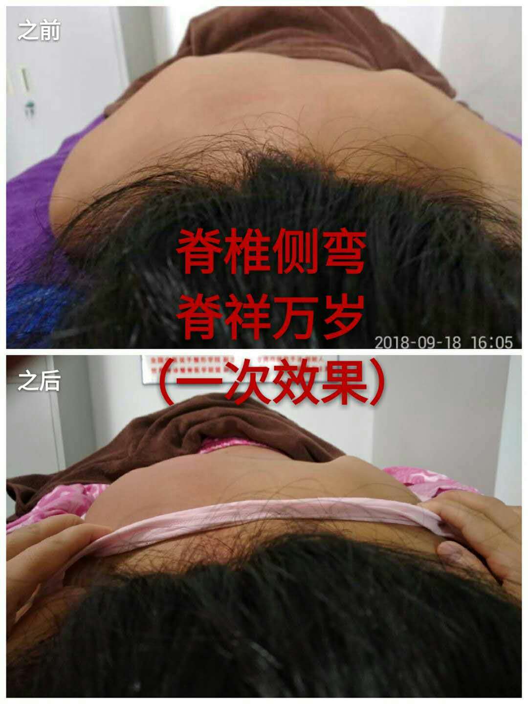 腰椎側(cè)彎