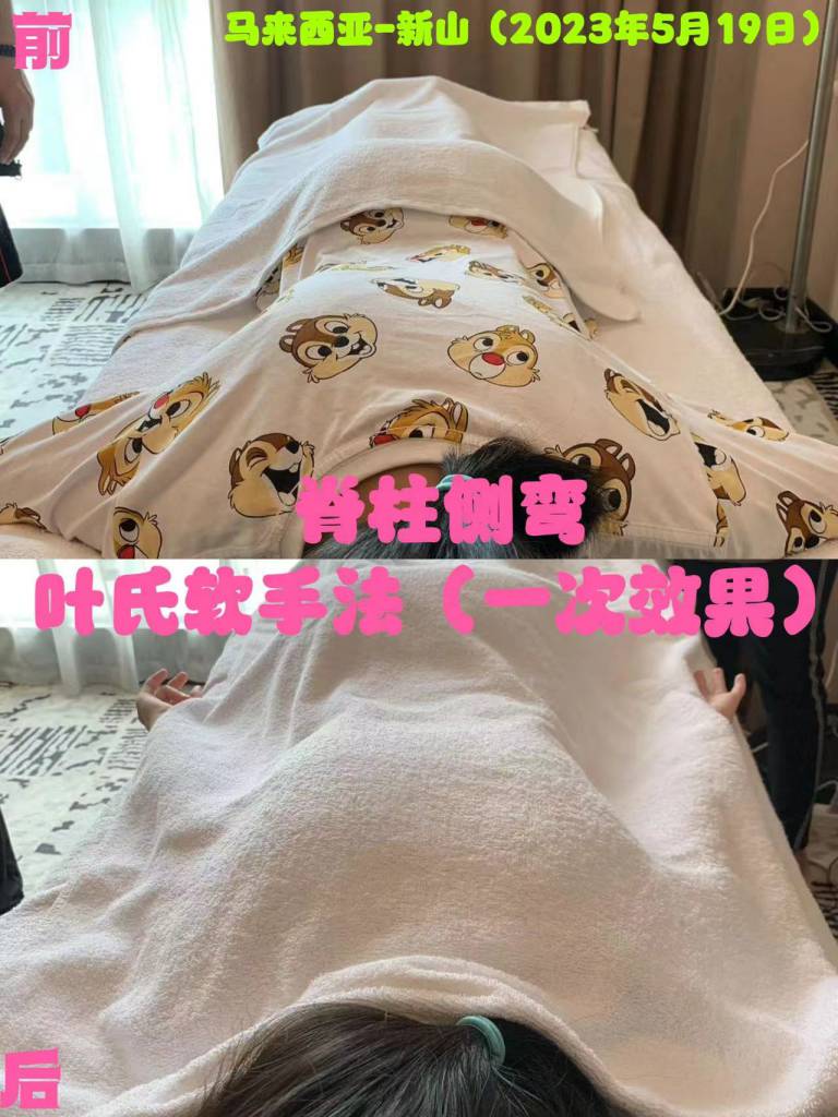 脊柱側(cè)彎 