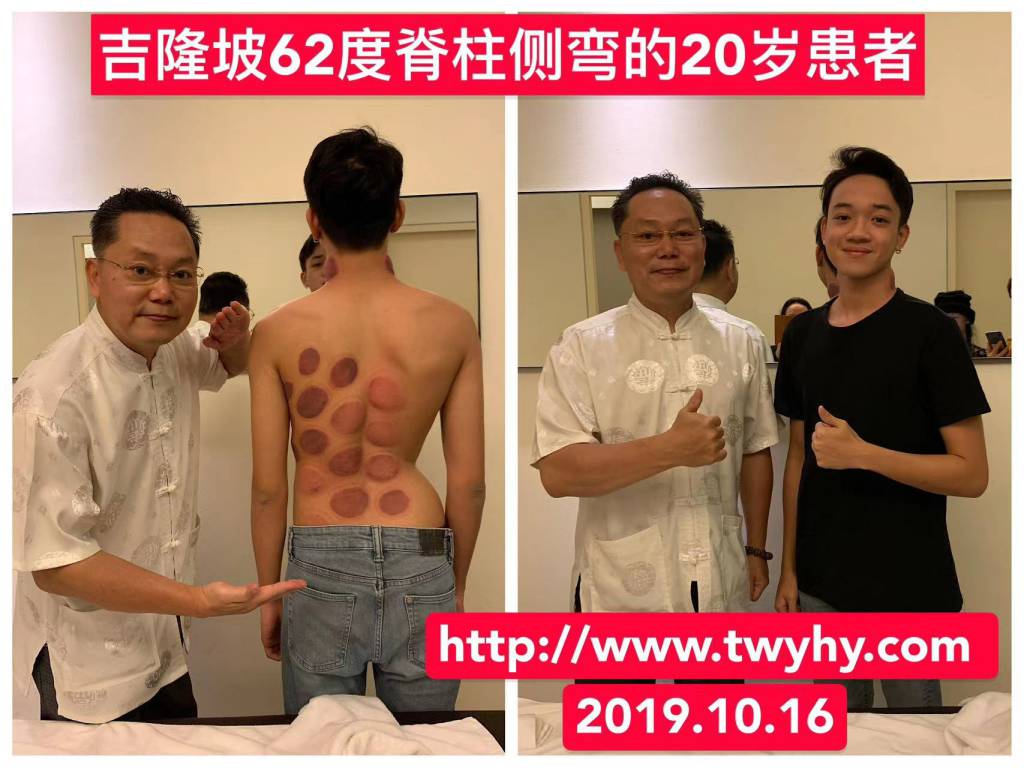 脊柱側(cè)彎 