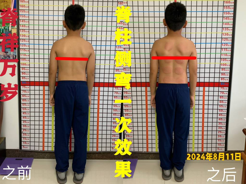 脊柱側(cè)彎 