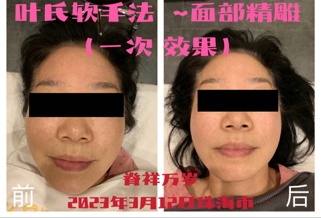 徒手整容案例
